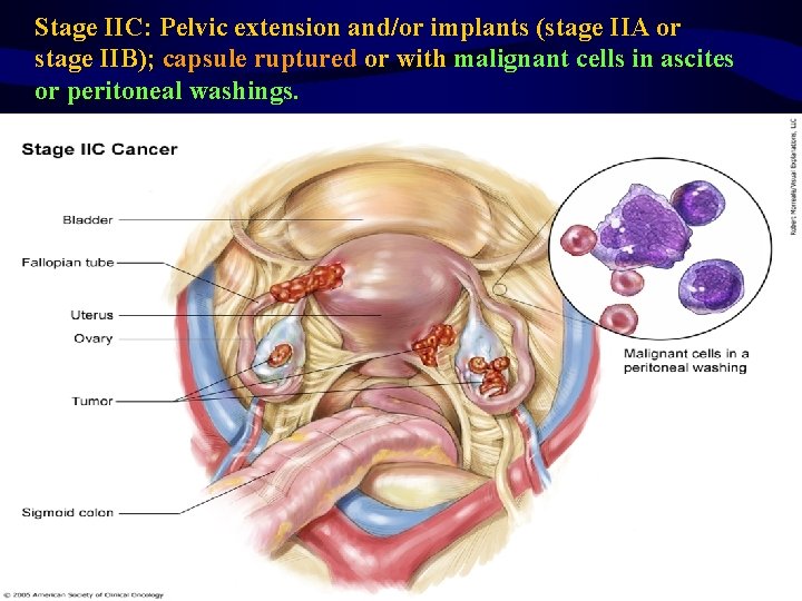 Stage IIC: Pelvic extension and/or implants (stage IIA or stage IIB); capsule ruptured or