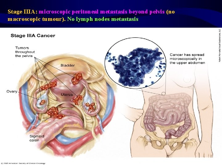 Stage IIIA: microscopic peritoneal metastasis beyond pelvis (no macroscopic tumour). No lymph nodes metastasis