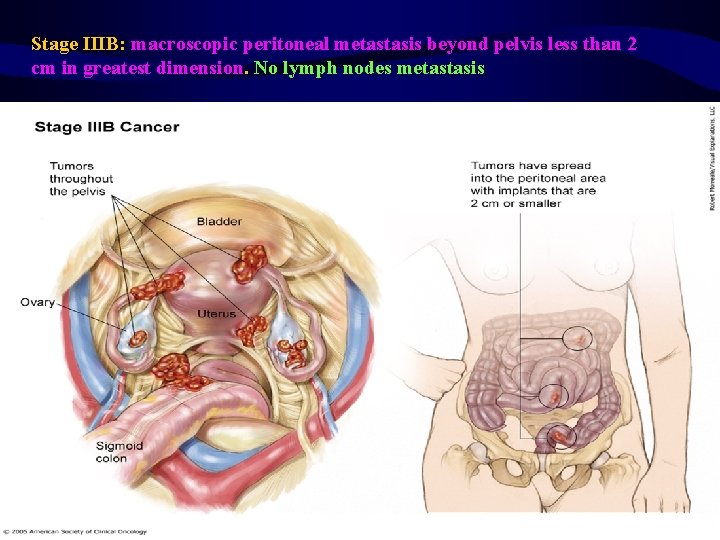 Stage IIIB: macroscopic peritoneal metastasis beyond pelvis less than 2 cm in greatest dimension.