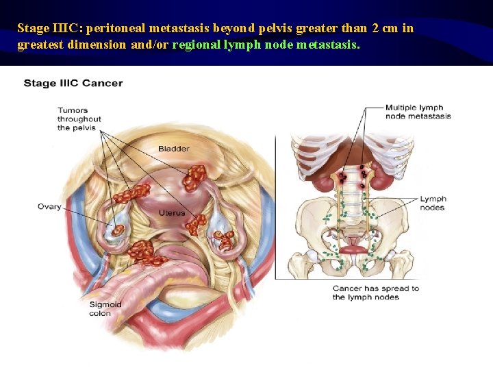 Stage IIIC: peritoneal metastasis beyond pelvis greater than 2 cm in greatest dimension and/or