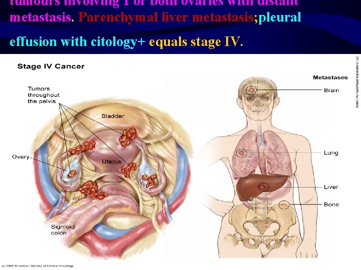 tumours involving 1 or both ovaries with distant metastasis. Parenchymal liver metastasis; pleural effusion