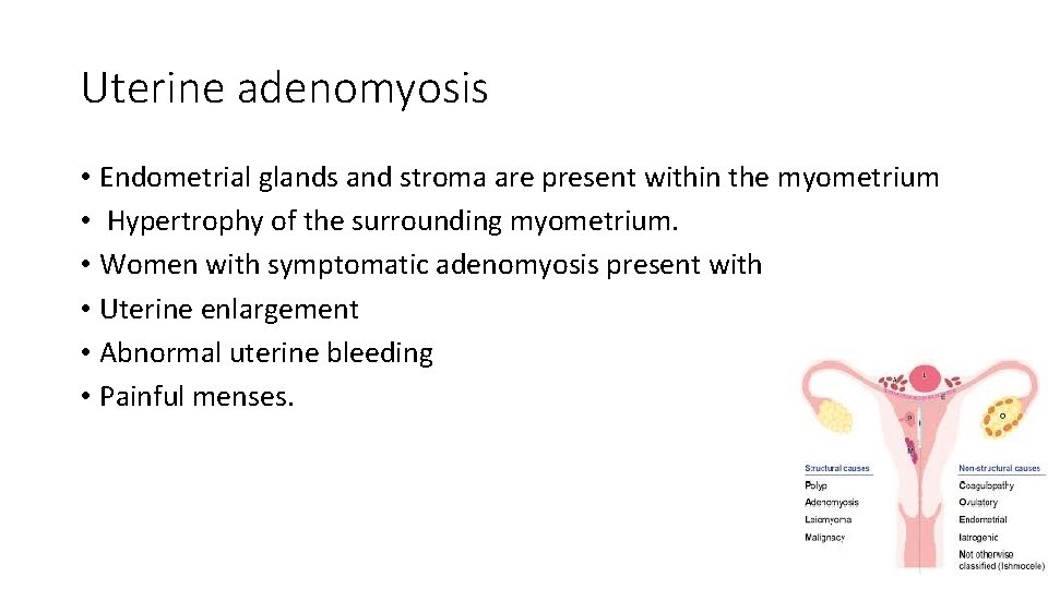 Uterine adenomyosis • Endometrial glands and stroma are present within the myometrium • Hypertrophy