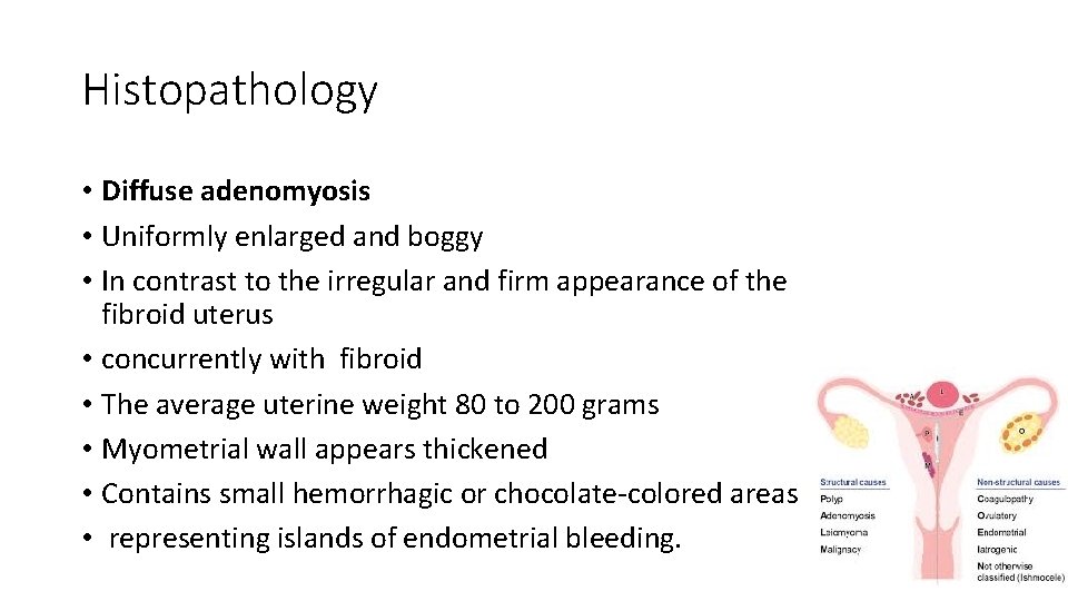 Histopathology • Diffuse adenomyosis • Uniformly enlarged and boggy • In contrast to the