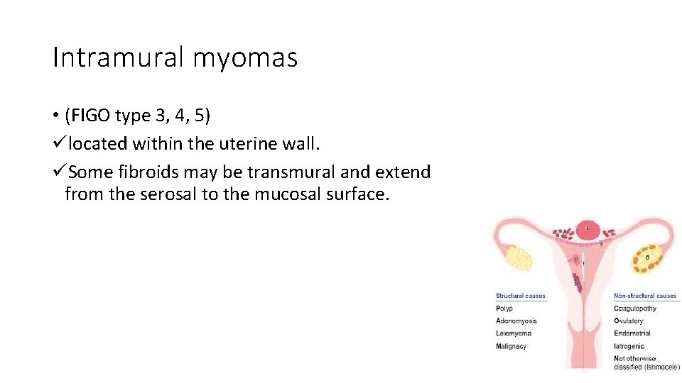 Intramural myomas • (FIGO type 3, 4, 5) ülocated within the uterine wall. üSome