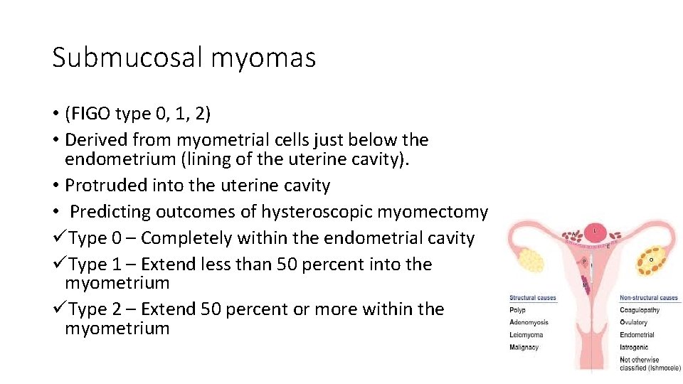 Submucosal myomas • (FIGO type 0, 1, 2) • Derived from myometrial cells just