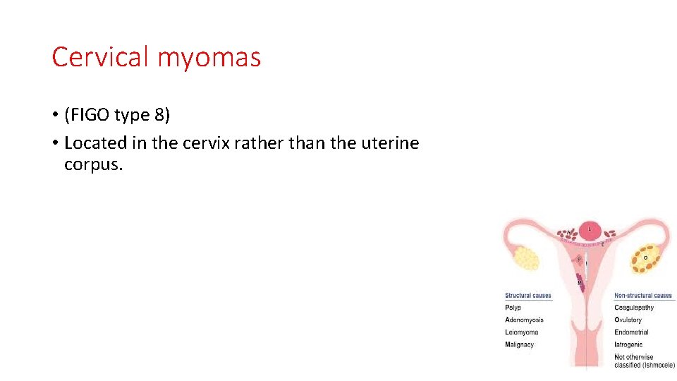 Cervical myomas • (FIGO type 8) • Located in the cervix rather than the