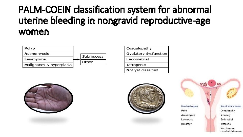 PALM-COEIN classification system for abnormal uterine bleeding in nongravid reproductive-age women 