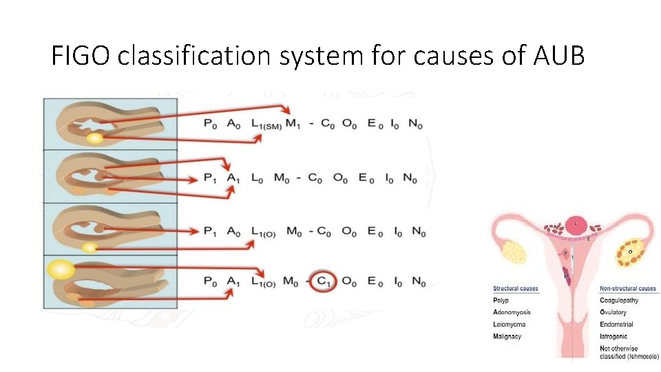 FIGO classification system for causes of AUB 