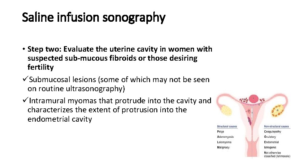 Saline infusion sonography • Step two: Evaluate the uterine cavity in women with suspected
