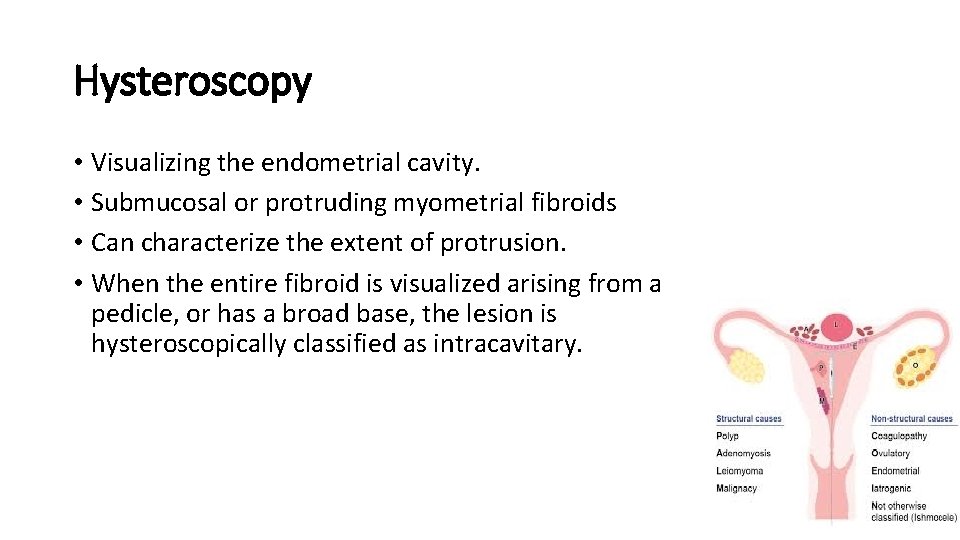 Hysteroscopy • Visualizing the endometrial cavity. • Submucosal or protruding myometrial fibroids • Can