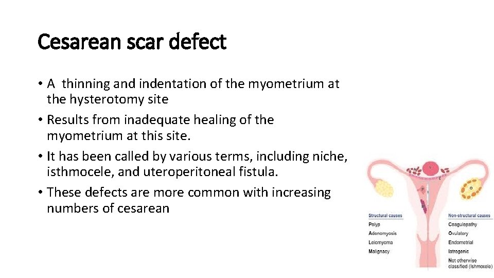 Cesarean scar defect • A thinning and indentation of the myometrium at the hysterotomy