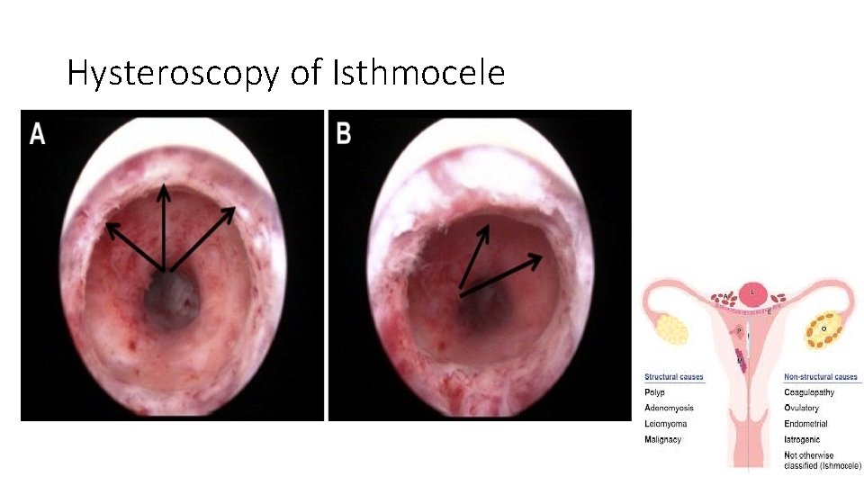 Hysteroscopy of Isthmocele 