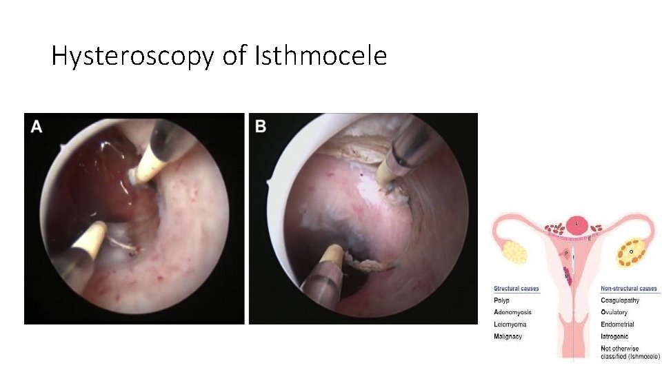 Hysteroscopy of Isthmocele 