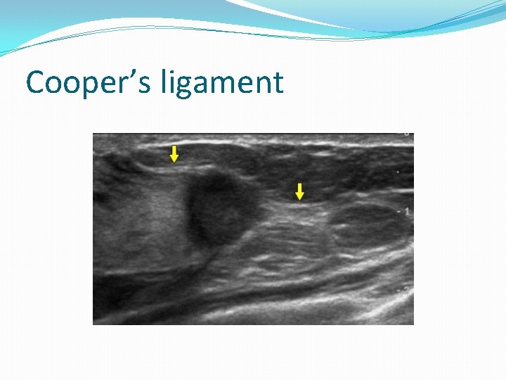 Cooper’s ligament 