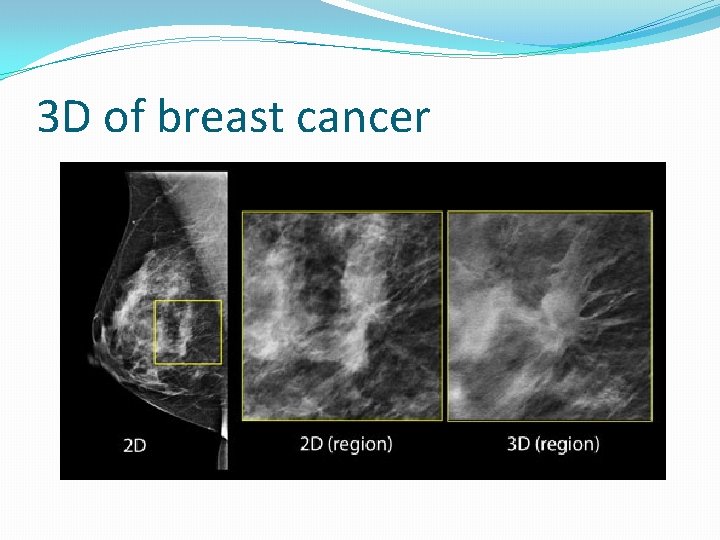 3 D of breast cancer 