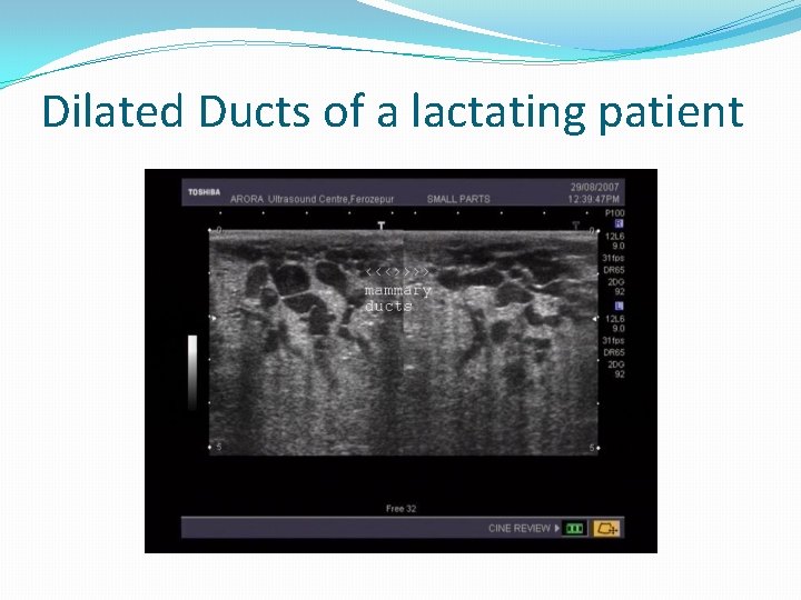 Dilated Ducts of a lactating patient 