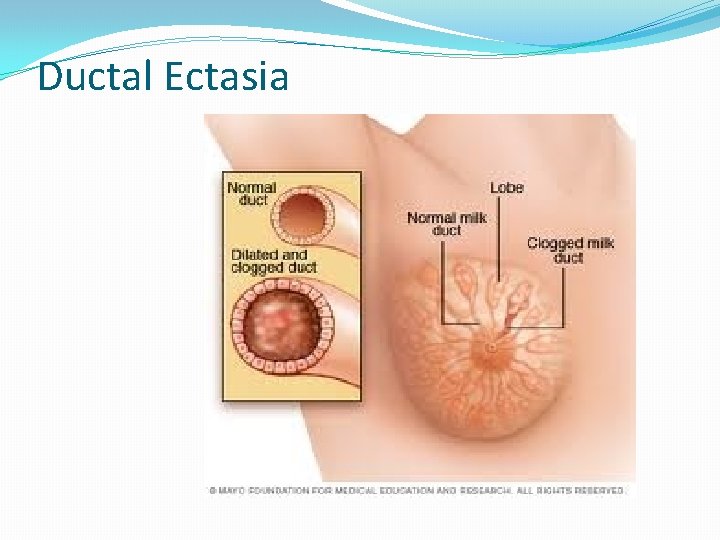 Ductal Ectasia 