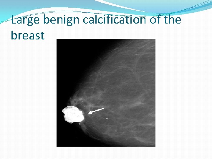 Large benign calcification of the breast 