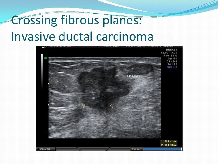 Crossing fibrous planes: Invasive ductal carcinoma 