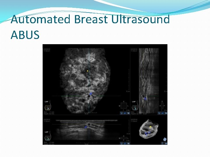 Automated Breast Ultrasound ABUS 