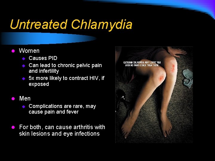 Untreated Chlamydia l Women u Causes PID u Can lead to chronic pelvic pain