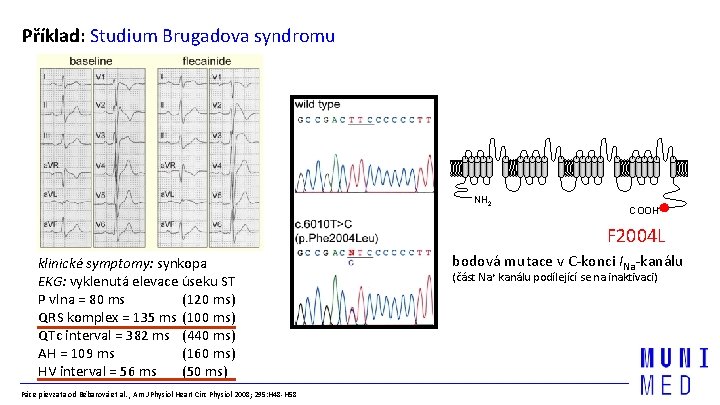 Příklad: Studium Brugadova syndromu NH 2 COOH F 2004 L klinické symptomy: synkopa EKG: