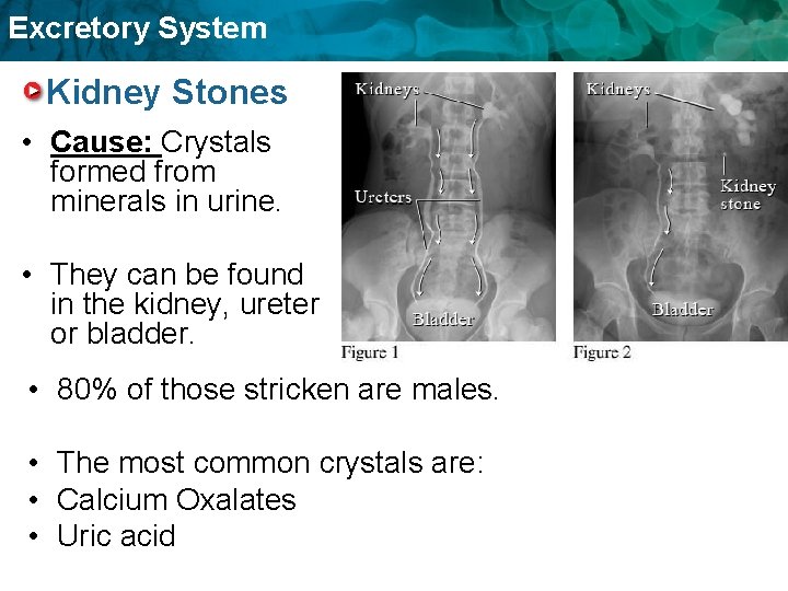 Excretory System Kidney Stones • Cause: Crystals formed from minerals in urine. • They Excretory System Kidney Stones • Cause: Crystals formed from minerals in urine. • They