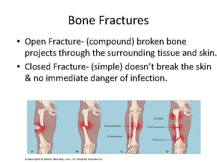 Bone Fractures • Open Fracture- (compound) broken bone projects through the surrounding tissue and