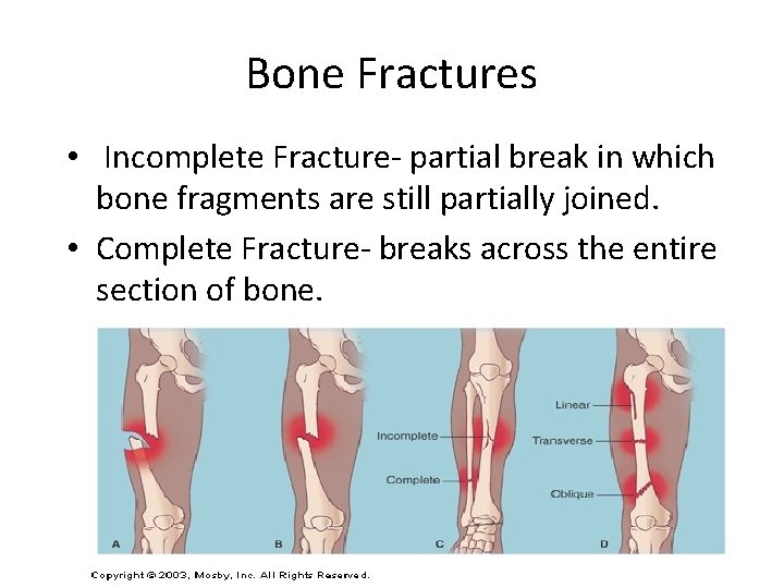 Bone Fractures • Incomplete Fracture- partial break in which bone fragments are still partially