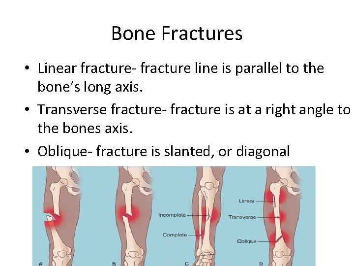 Bone Fractures • Linear fracture- fracture line is parallel to the bone’s long axis.