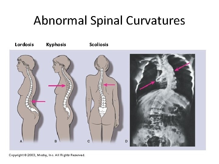 Abnormal Spinal Curvatures Lordosis Kyphosis Scoliosis 