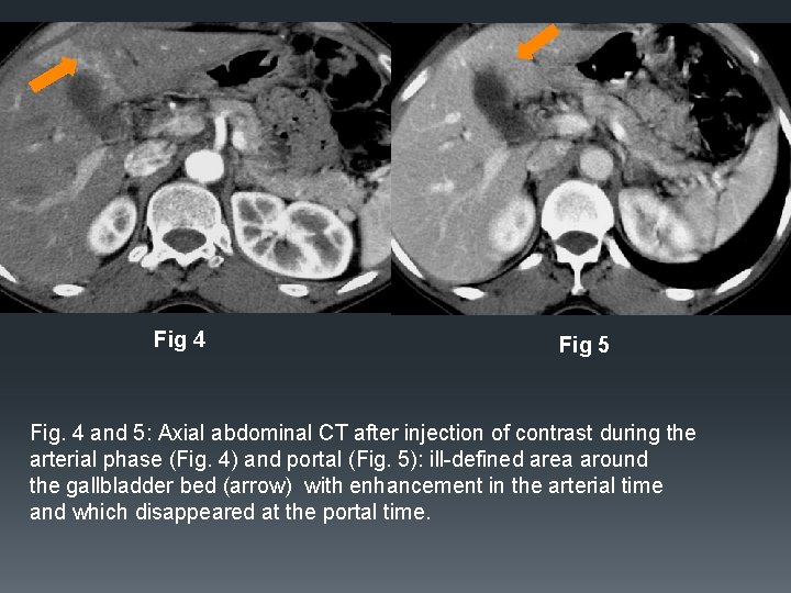 Fig 4 Fig 5 Fig. 4 and 5: Axial abdominal CT after injection of