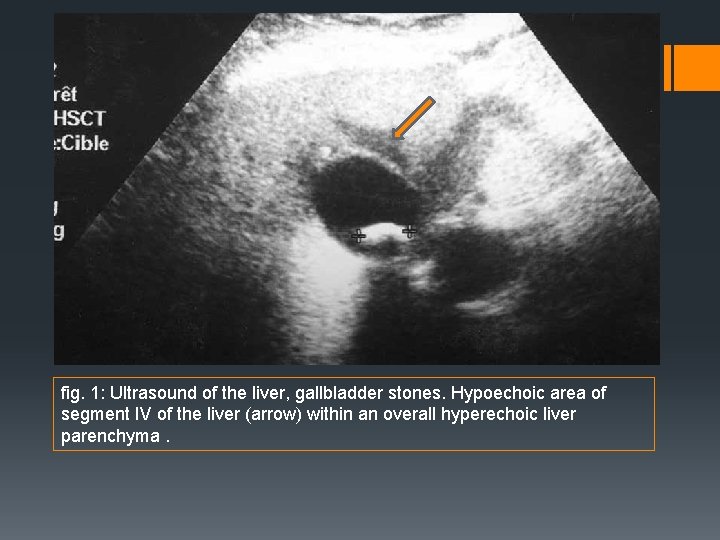 fig. 1: Ultrasound of the liver, gallbladder stones. Hypoechoic area of segment IV of