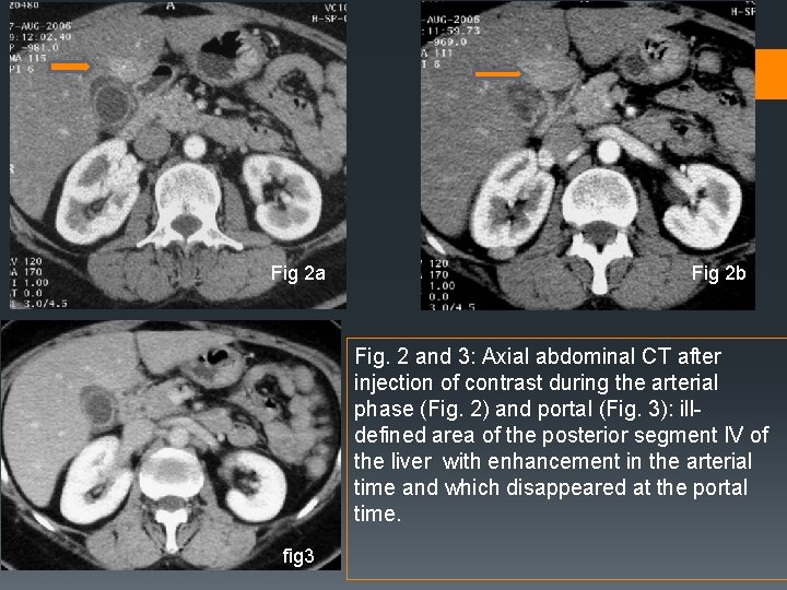 Fig 2 a Fig 2 b Fig. 2 and 3: Axial abdominal CT after