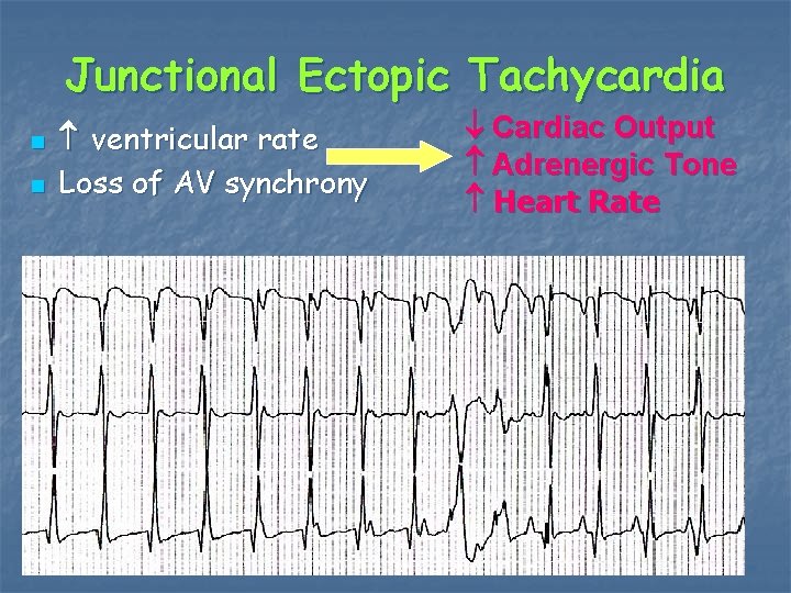 Junctional Ectopic Tachycardia n n ventricular rate Loss of AV synchrony Cardiac Output Adrenergic