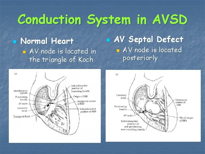 Conduction System in AVSD n Normal Heart n AV node is located in the