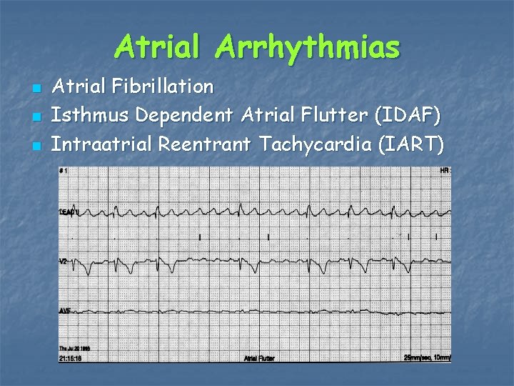 Atrial Arrhythmias n n n Atrial Fibrillation Isthmus Dependent Atrial Flutter (IDAF) Intraatrial Reentrant