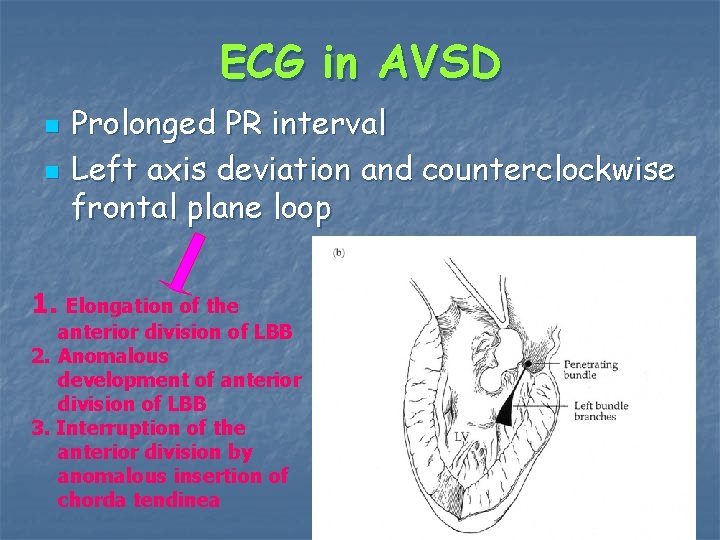 ECG in AVSD n n Prolonged PR interval Left axis deviation and counterclockwise frontal