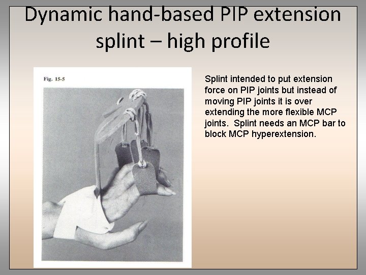 Dynamic hand-based PIP extension splint – high profile Splint intended to put extension force