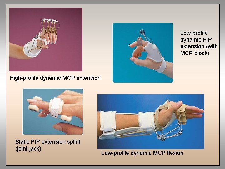 Low-profile dynamic PIP extension (with MCP block) High-profile dynamic MCP extension Static PIP extension