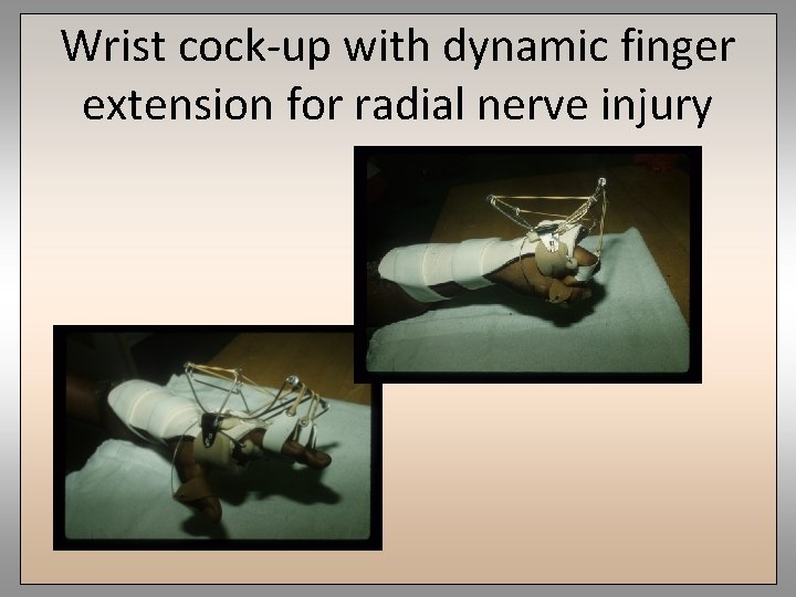 Wrist cock-up with dynamic finger extension for radial nerve injury 