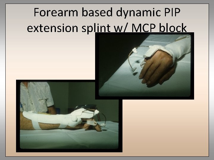 Forearm based dynamic PIP extension splint w/ MCP block 