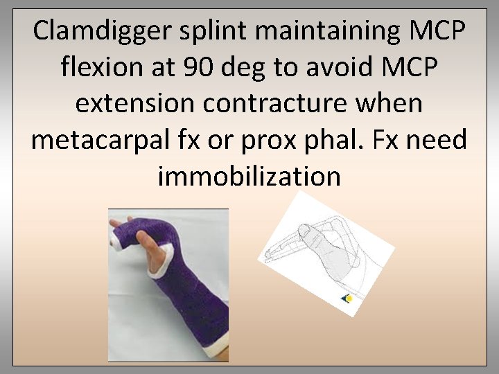 Clamdigger splint maintaining MCP flexion at 90 deg to avoid MCP extension contracture when