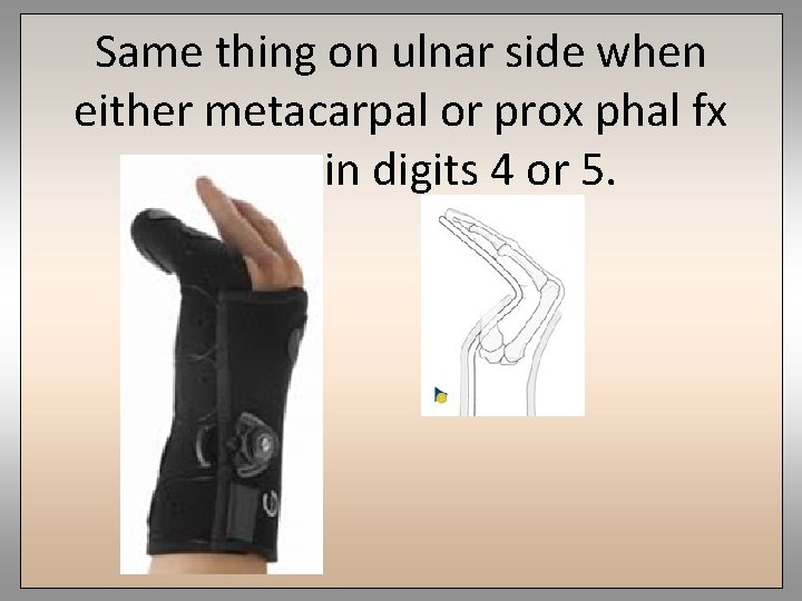 Same thing on ulnar side when either metacarpal or prox phal fx occurs in