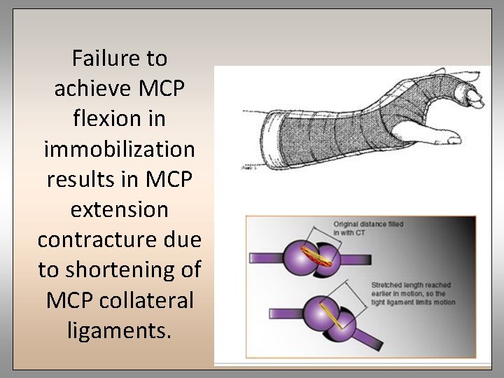 Failure to achieve MCP flexion in immobilization results in MCP extension contracture due to