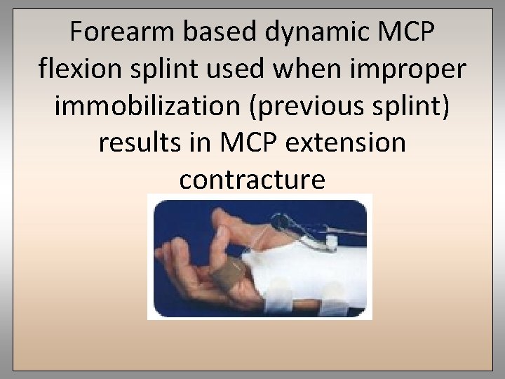 Forearm based dynamic MCP flexion splint used when improper immobilization (previous splint) results in