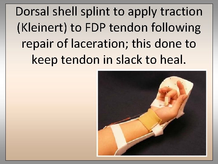 Dorsal shell splint to apply traction (Kleinert) to FDP tendon following repair of laceration;