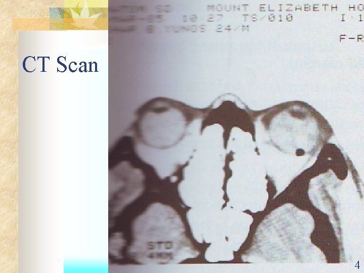 CT Scan 4 