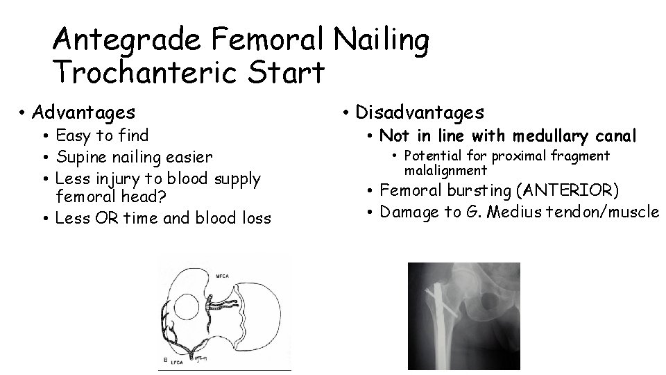 Antegrade Femoral Nailing Trochanteric Start • Advantages • Easy to find • Supine nailing