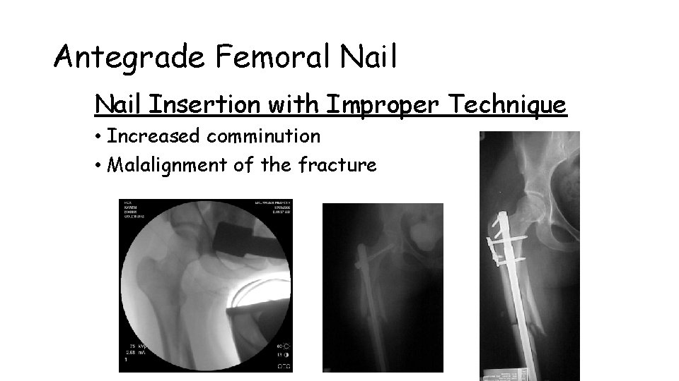 Antegrade Femoral Nail Insertion with Improper Technique • Increased comminution • Malalignment of the